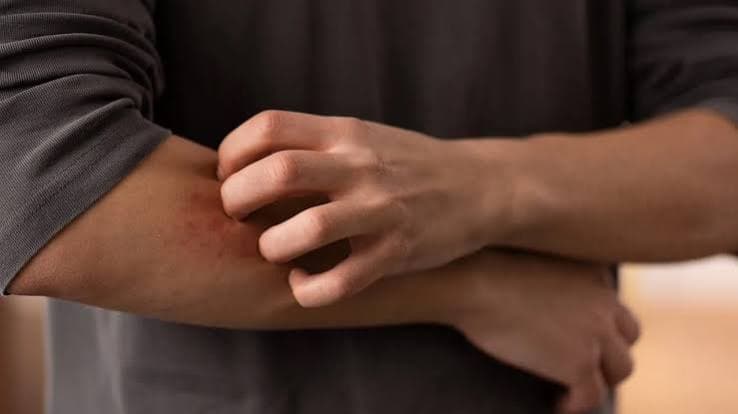 Aumento dei casi di dermatofilosi in Europa. Pregliasco: «Rischio contenuto, ma cambiano le modalità di trasmissione»